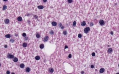 histology of diffuse astrocytoma