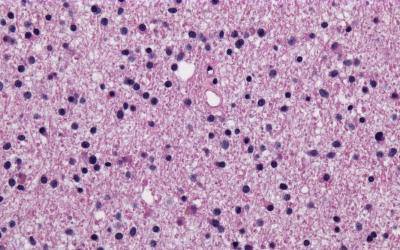 histology of diffuse astrocytoma, a low-grade glioma